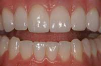 Los Angeles Porcelain Crowns