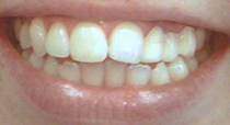 Porcelain Veneers