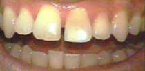 Porcelain Veneers