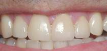 Porcelain Veneers