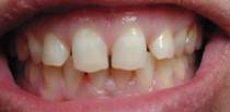 Los Angeles Dental Veneers