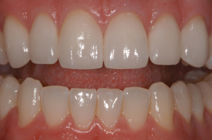 Los Angeles Dental Implants