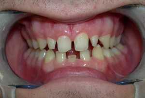 Los Angeles Porcelain Crowns