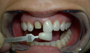 Recement Veneer