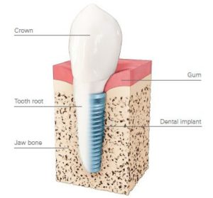 Dental Implant Dentist