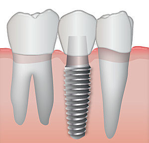 Dental Implants Los Angeles