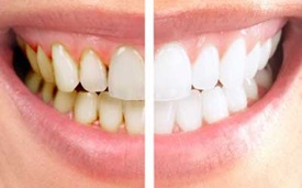 cosmetic-dentistry-can-do-for-you-2