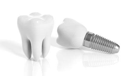 Dental Implants