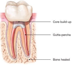 Root Canal