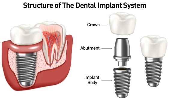 Different Kinds of Dental Implants - Larchmont Dental Associates